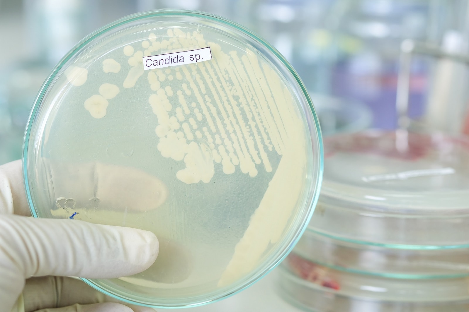 Gljivične infekcije – kako ih spriječiti i liječiti?